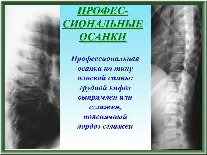 ПРОФЕССИОНАЛЬНЫЕ ОСАНКИ Профессиональная осанка по типу плоской спины: грудной кифоз выпрямлен или сглажен, поясничный