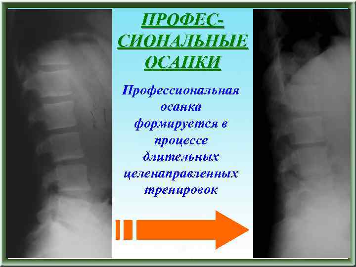 ПРОФЕССИОНАЛЬНЫЕ ОСАНКИ Профессиональная осанка формируется в процессе длительных целенаправленных тренировок 