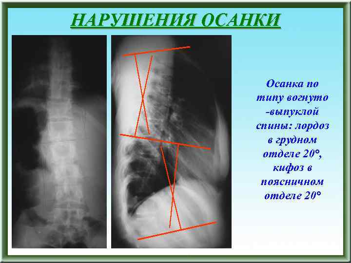 НАРУШЕНИЯ ОСАНКИ Осанка по типу вогнуто -выпуклой спины: лордоз в грудном отделе 20°, кифоз