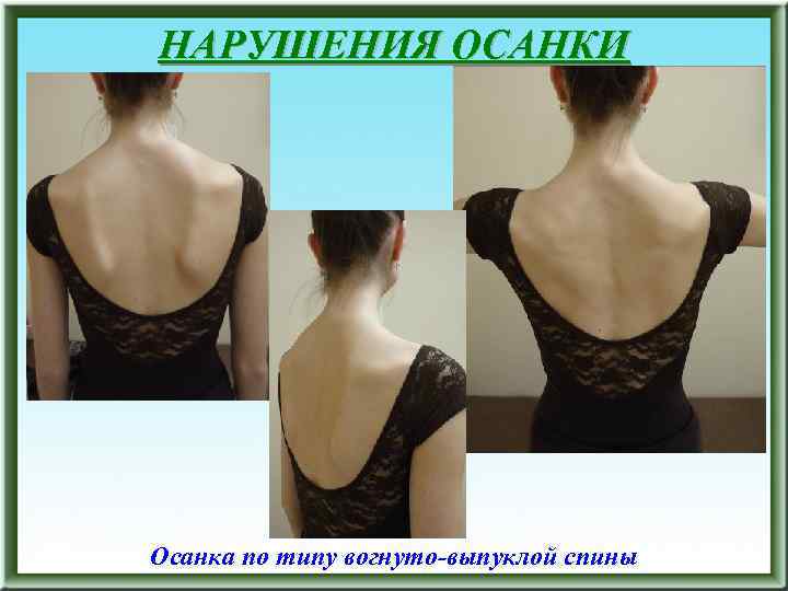 НАРУШЕНИЯ ОСАНКИ Осанка по типу вогнуто-выпуклой спины 