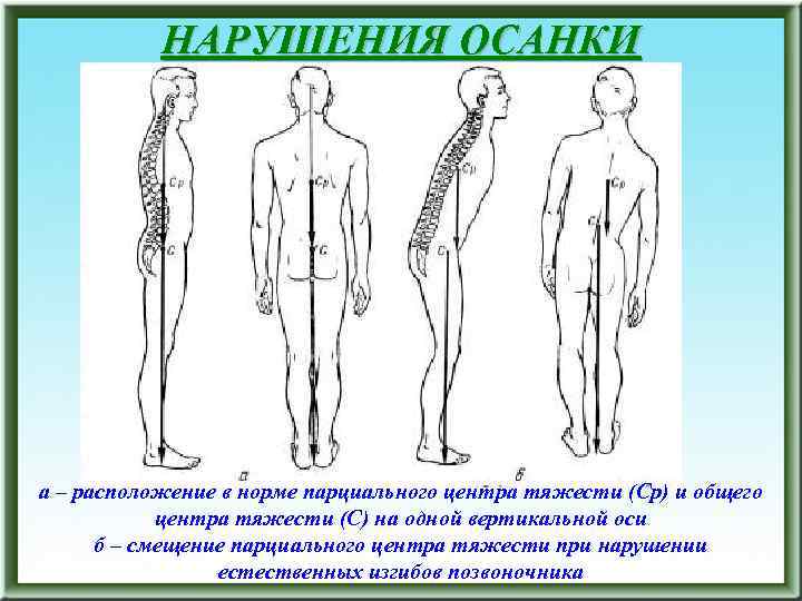 НАРУШЕНИЯ ОСАНКИ а – расположение в норме парциального центра тяжести (Ср) и общего центра