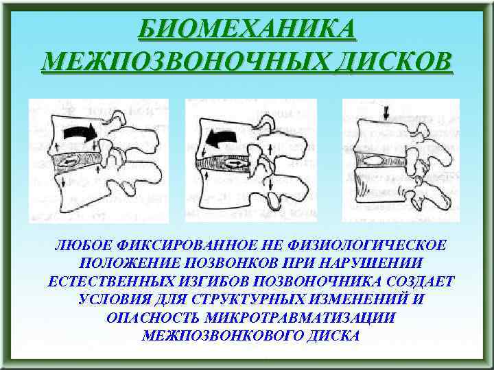 БИОМЕХАНИКА МЕЖПОЗВОНОЧНЫХ ДИСКОВ ЛЮБОЕ ФИКСИРОВАННОЕ НЕ ФИЗИОЛОГИЧЕСКОЕ ПОЛОЖЕНИЕ ПОЗВОНКОВ ПРИ НАРУШЕНИИ ЕСТЕСТВЕННЫХ ИЗГИБОВ ПОЗВОНОЧНИКА