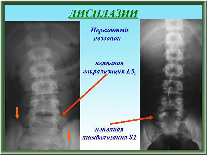 ДИСПЛАЗИИ Переходный позвонок – неполная сакрализация L 5, неполная люмбализация S 1 