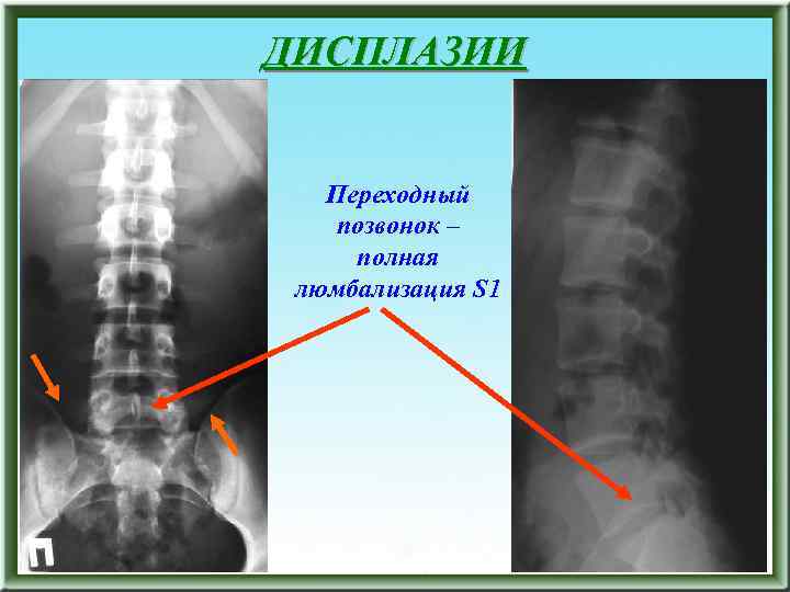 ДИСПЛАЗИИ Переходный позвонок – полная люмбализация S 1 