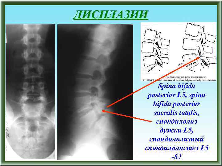 ДИСПЛАЗИИ Spina bifida posterior L 5, spina bifida posterior sacralis totalis, спондилолиз дужки L