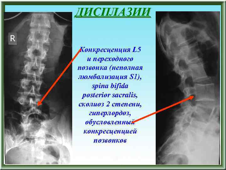 ДИСПЛАЗИИ Конкресценция L 5 и переходного позвонка (неполная люмбализация S 1), spina bifida posterior