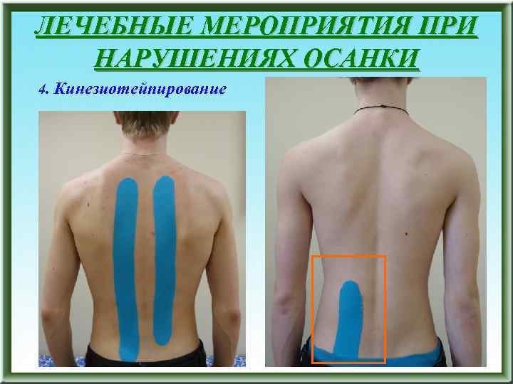 ЛЕЧЕБНЫЕ МЕРОПРИЯТИЯ ПРИ НАРУШЕНИЯХ ОСАНКИ 4. Кинезиотейпирование 