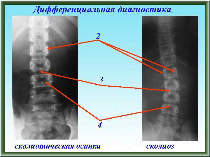 Дифференциальная диагностика 2 3 4 сколиотическая осанка сколиоз 
