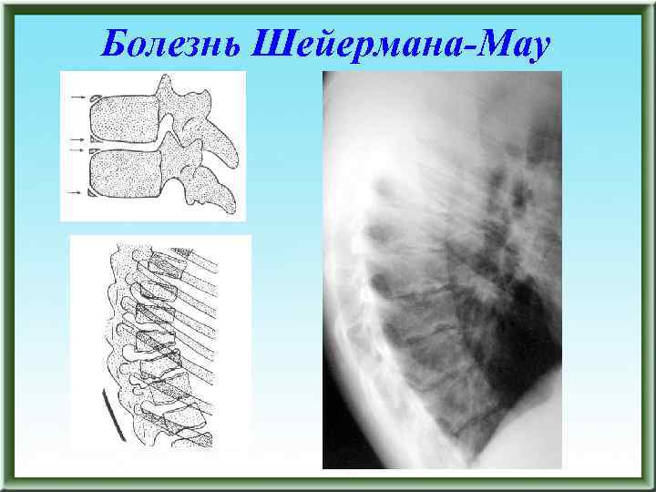 Болезнь Шейермана-Мау 
