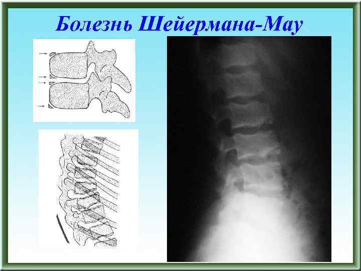 Болезнь Шейермана-Мау 