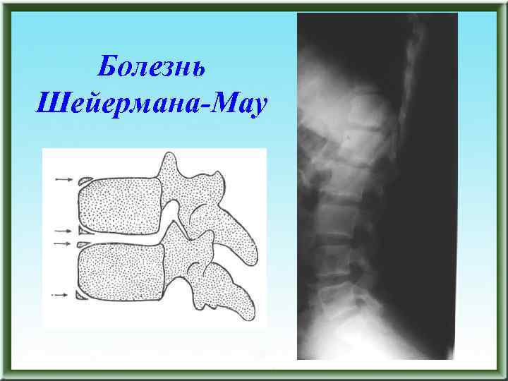 Болезнь Шейермана-Мау 