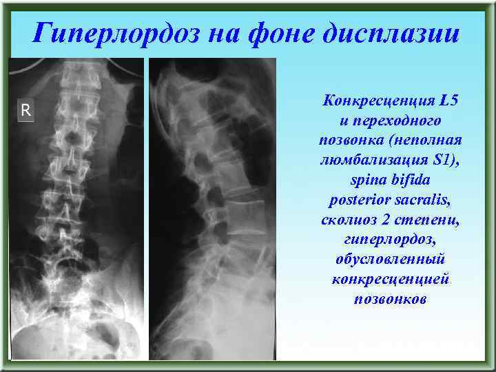 Гиперлордоз на фоне дисплазии Конкресценция L 5 и переходного позвонка (неполная люмбализация S 1),