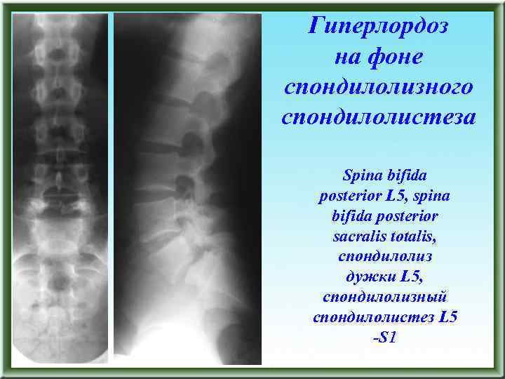 Гиперлордоз на фоне спондилолизного спондилолистеза Spina bifida posterior L 5, spina bifida posterior sacralis