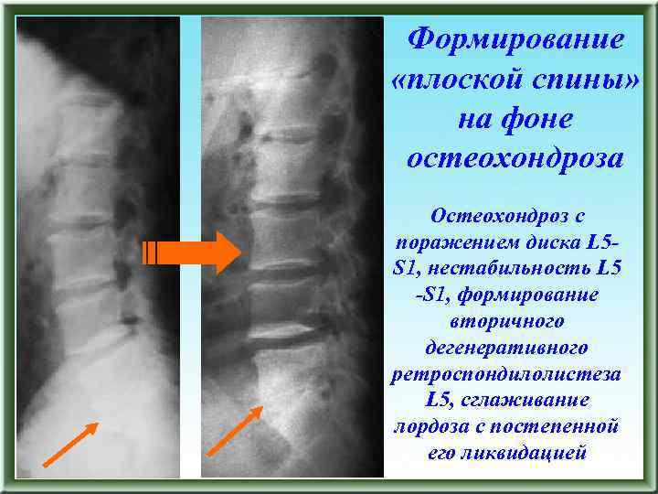 Формирование «плоской спины» на фоне остеохондроза Остеохондроз с поражением диска L 5 S 1,