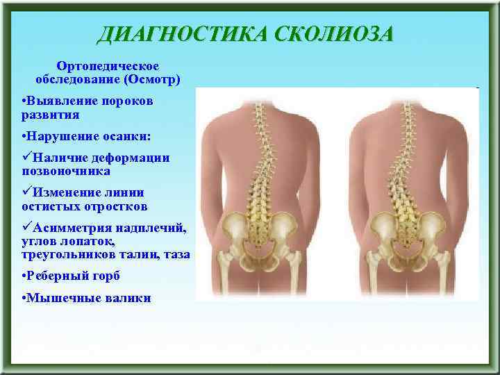 ДИАГНОСТИКА СКОЛИОЗА Ортопедическое обследование (Осмотр) • Выявление пороков развития • Нарушение осанки: üНаличие деформации