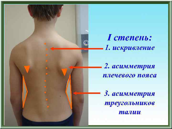I степень: 1. искривление 2. асимметрия плечевого пояса 3. асимметрия треугольников талии 