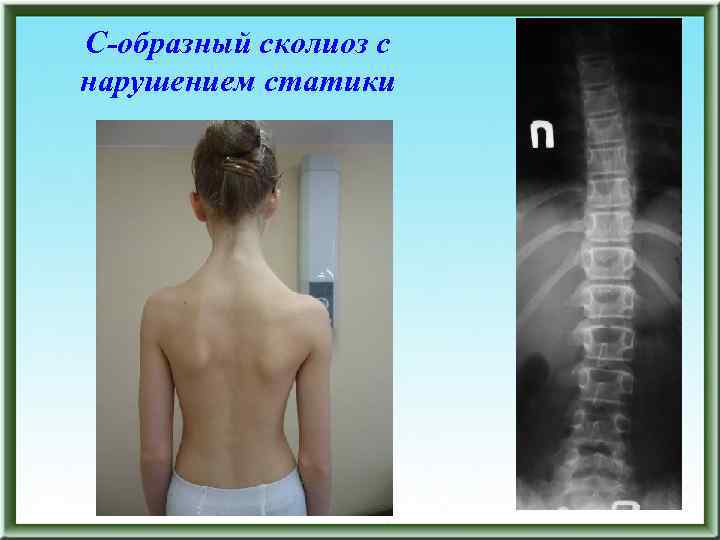 С-образный сколиоз с нарушением статики 