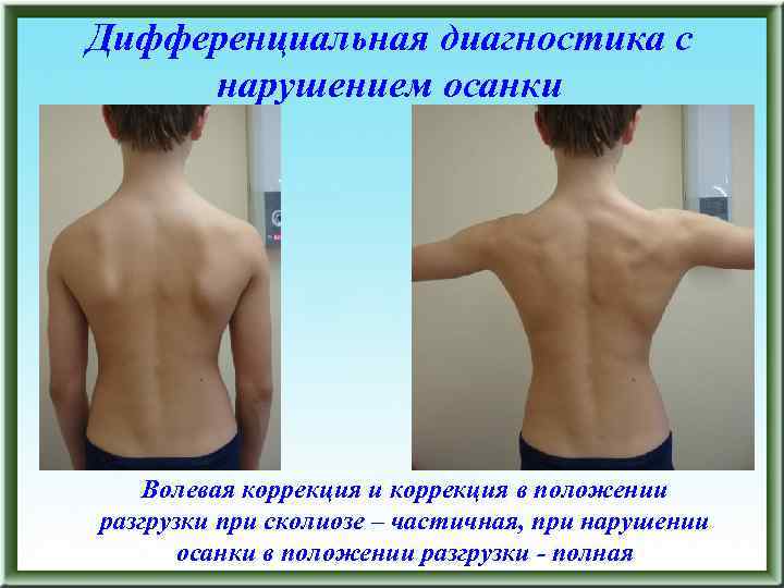 Дифференциальная диагностика с нарушением осанки Волевая коррекция и коррекция в положении разгрузки при сколиозе