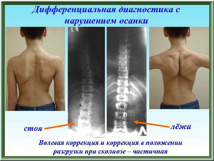 Дифференциальная диагностика с нарушением осанки стоя лёжа Волевая коррекция и коррекция в положении разгрузки