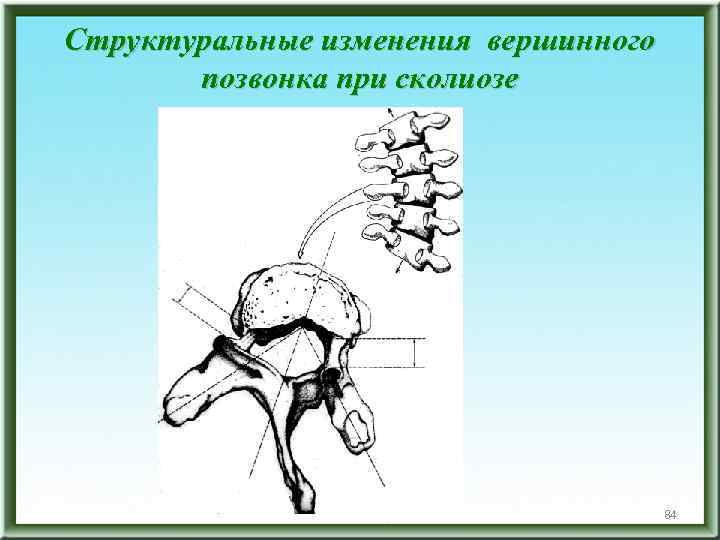 Структуральные изменения вершинного позвонка при сколиозе 84 