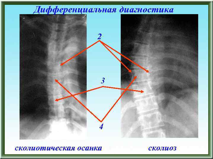 Дифференциальная диагностика 2 3 4 сколиотическая осанка сколиоз 