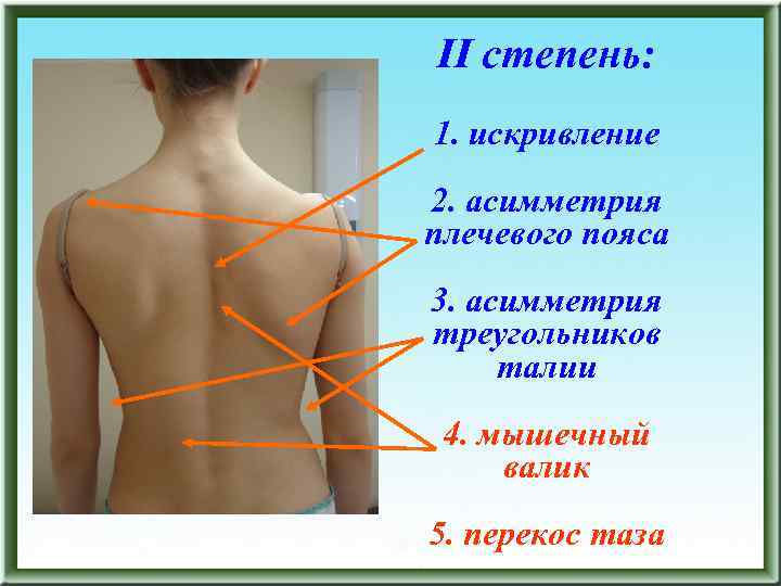 II степень: 1. искривление 2. асимметрия плечевого пояса 3. асимметрия треугольников талии 4. мышечный