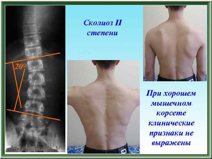 Сколиоз II степени 20° При хорошем мышечном корсете клинические признаки не выражены 