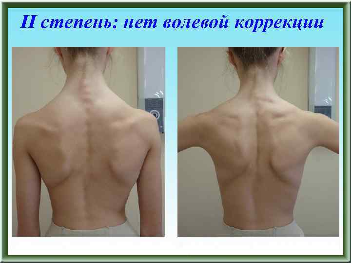 II степень: нет волевой коррекции 