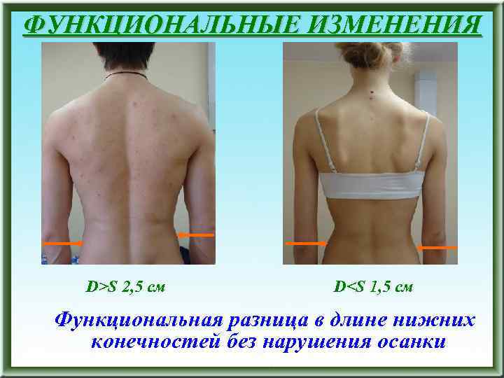 ФУНКЦИОНАЛЬНЫЕ ИЗМЕНЕНИЯ D>S 2, 5 см D<S 1, 5 см Функциональная разница в длине