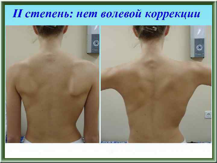 II степень: нет волевой коррекции 