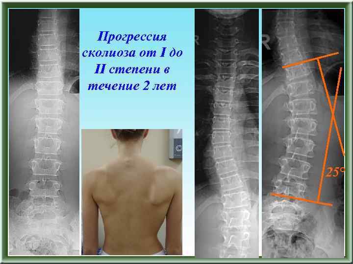 Прогрессия сколиоза от I до II степени в течение 2 лет 25° 