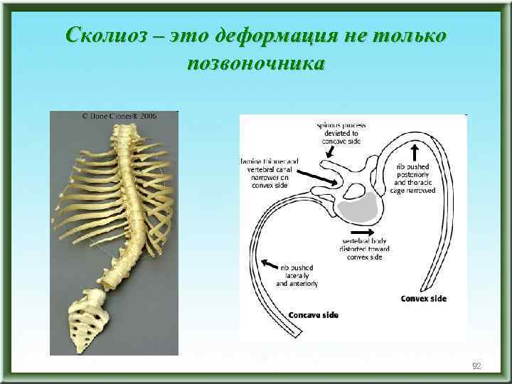 Сколиоз – это деформация не только позвоночника 92 