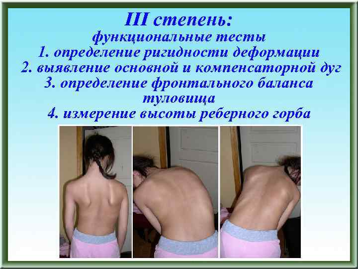 III степень: функциональные тесты 1. определение ригидности деформации 2. выявление основной и компенсаторной дуг
