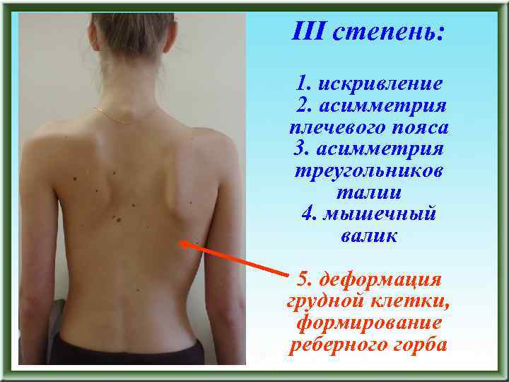 III степень: 1. искривление 2. асимметрия плечевого пояса 3. асимметрия треугольников талии 4. мышечный
