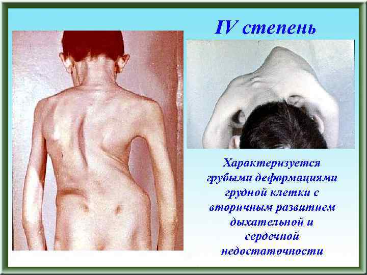 IV степень Характеризуется грубыми деформациями грудной клетки с вторичным развитием дыхательной и сердечной недостаточности