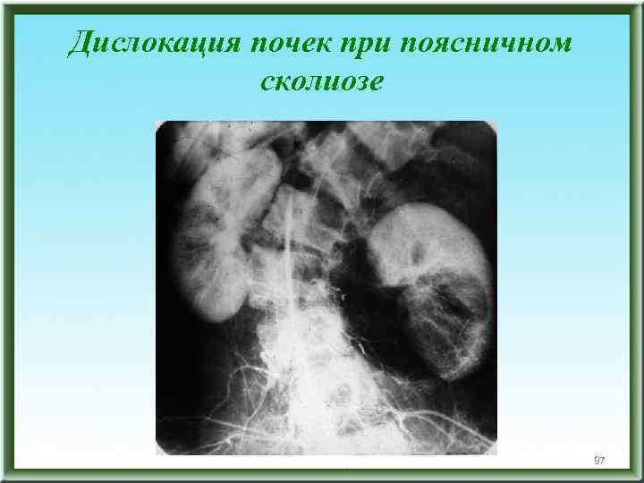Дислокация почек при поясничном сколиозе 97 