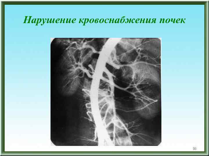 Нарушение кровоснабжения почек 98 