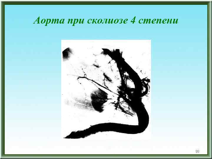 Аорта при сколиозе 4 степени 99 