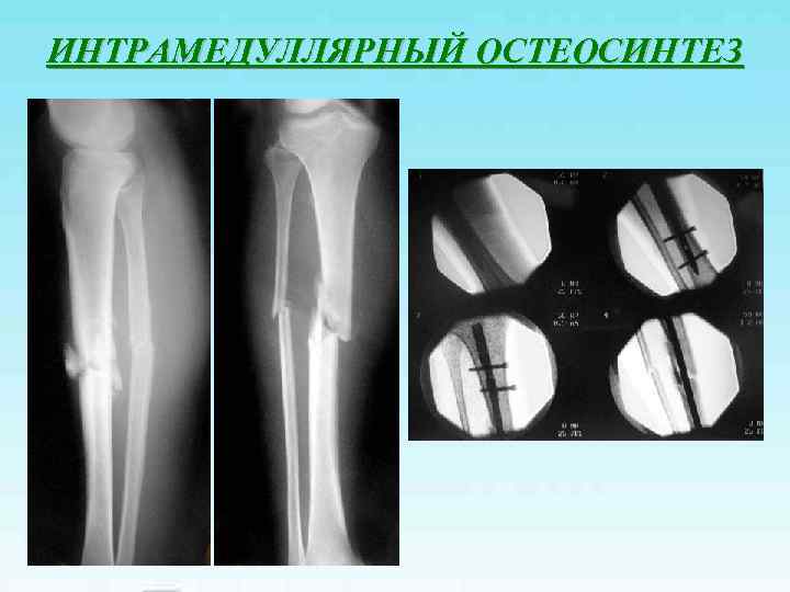 ИНТРАМЕДУЛЛЯРНЫЙ ОСТЕОСИНТЕЗ 