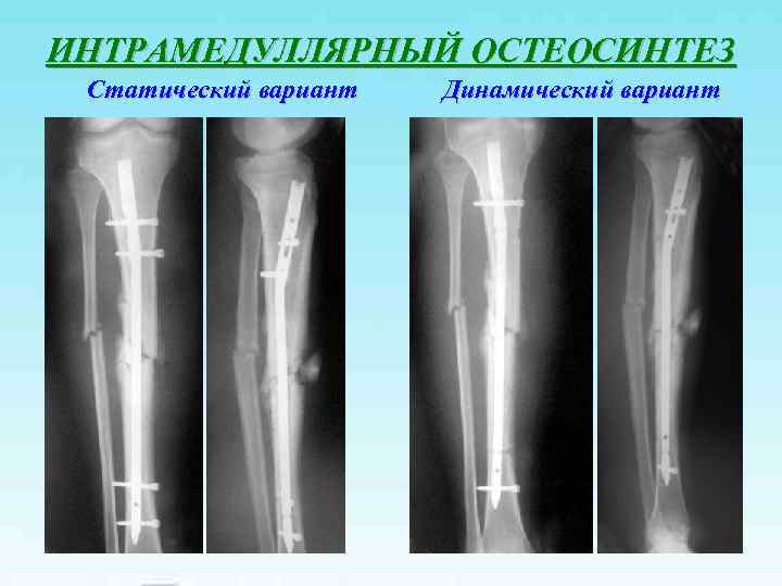 Диафиза большеберцовой кости фото