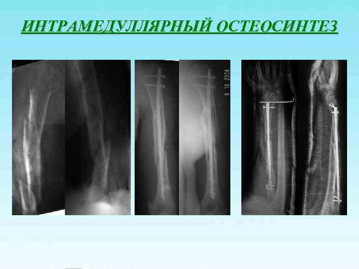 ИНТРАМЕДУЛЛЯРНЫЙ ОСТЕОСИНТЕЗ 