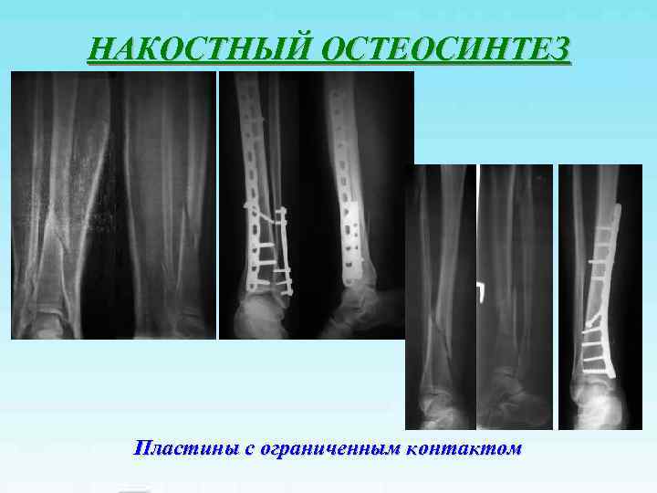 НАКОСТНЫЙ ОСТЕОСИНТЕЗ Пластины с ограниченным контактом 