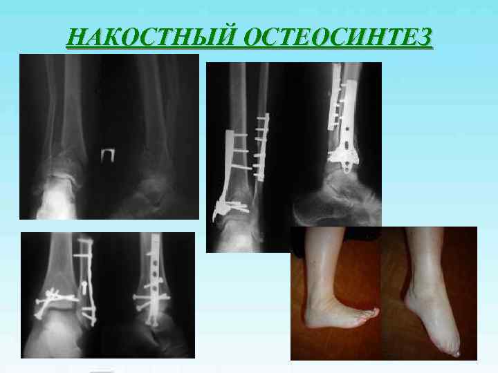 НАКОСТНЫЙ ОСТЕОСИНТЕЗ 