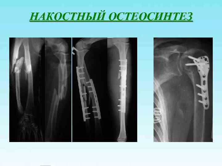 НАКОСТНЫЙ ОСТЕОСИНТЕЗ 