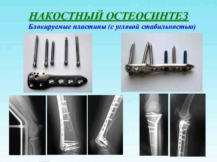 Внеочаговый остеосинтез презентация