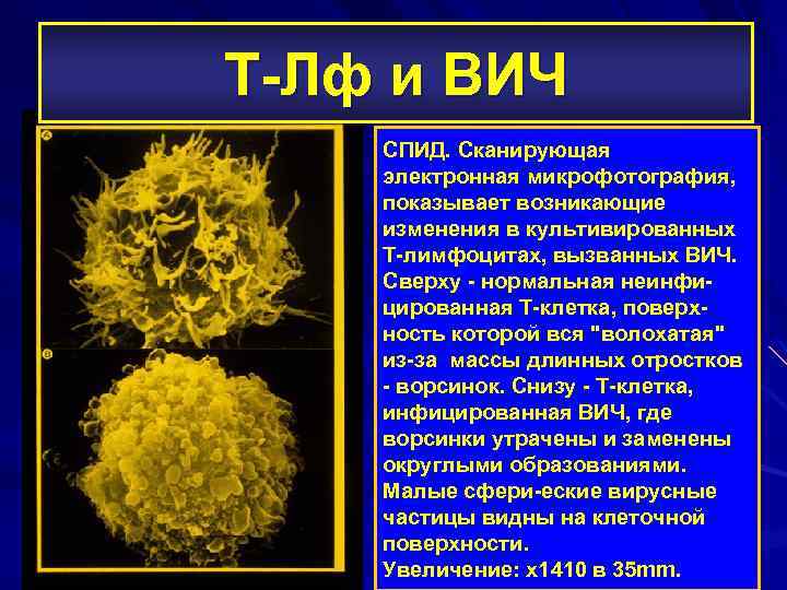 Т-Лф и ВИЧ СПИД. Cканирующая электронная микрофотография, показывает возникающие изменения в культивированных Т-лимфоцитах, вызванных