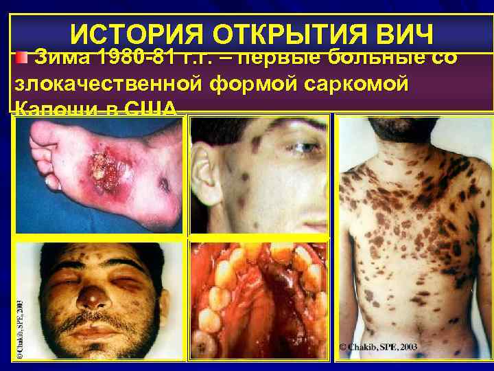 ИСТОРИЯ ОТКРЫТИЯ ВИЧ Зима 1980 -81 г. г. – первые больные со злокачественной формой