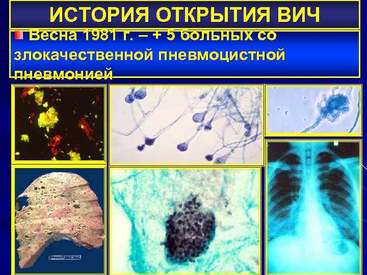 ИСТОРИЯ ОТКРЫТИЯ ВИЧ Весна 1981 г. – + 5 больных со злокачественной пневмоцистной пневмонией