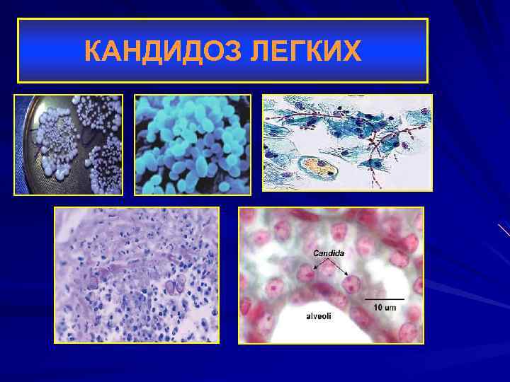 КАНДИДОЗ ЛЕГКИХ 