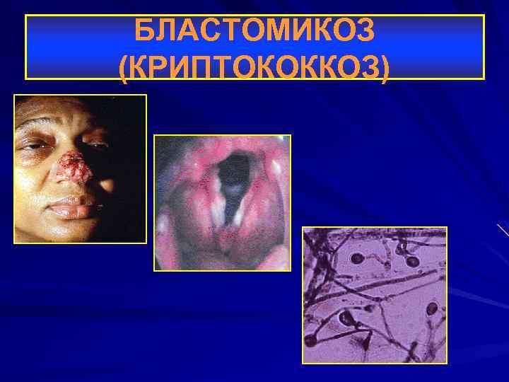 БЛАСТОМИКОЗ (КРИПТОКОККОЗ) 